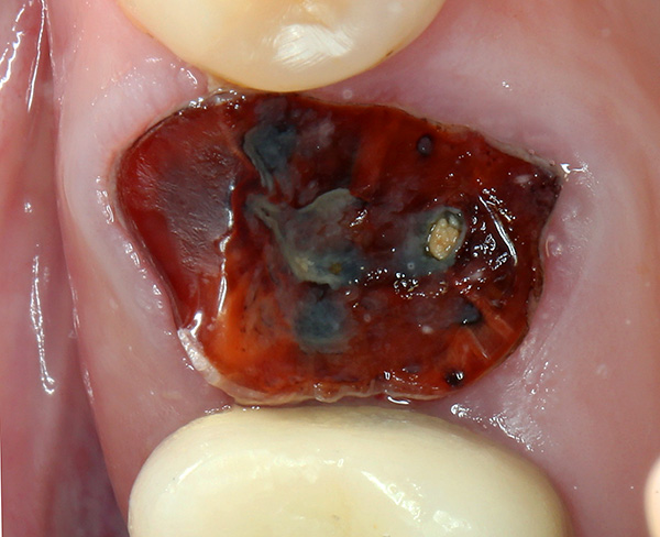 A través de las raíces de los dientes podridos se deben eliminar sin falta, y cuanto antes se haga, mejor.
