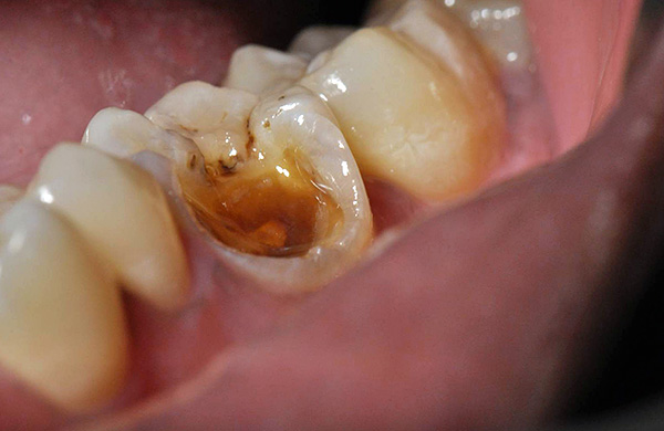 Si una pieza se ha desprendido de un diente, incluso si es grande, esto no significa que tenga que desprenderse del diente.