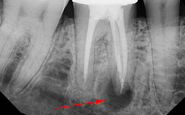 La radiografía muestra claramente un quiste dental en el área del ápice de la raíz.