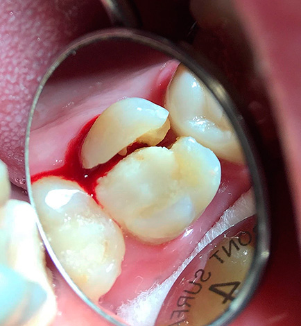 Con una fractura del diente de este tipo, suele estar sujeta a extracción.