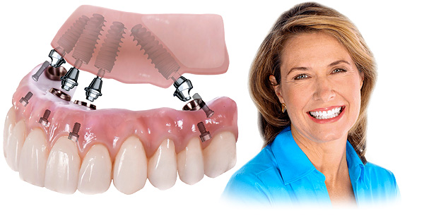 Познаваме технологиите за зъботехнически протези All-on-4 и All-on-6, техните предимства и недостатъци ...