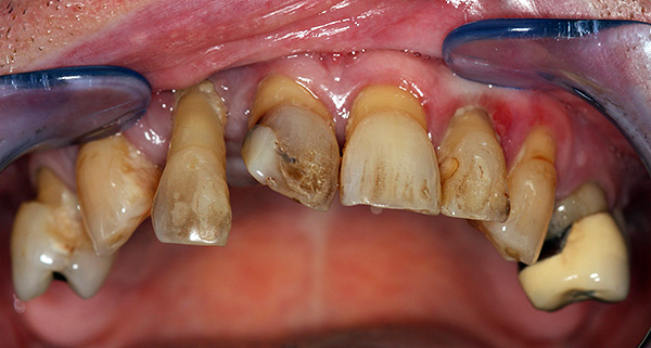 Otro ejemplo del estado de los dientes en la mandíbula superior antes del tratamiento ...