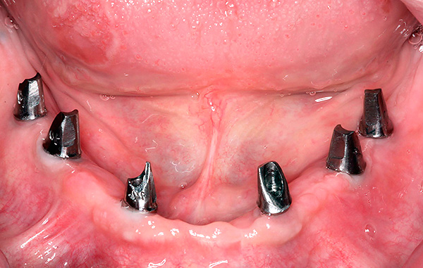 Cuando se utilizan prótesis con tecnología All-on-6, se utilizan 6 implantes.