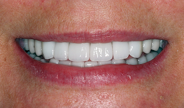 A pesar del hecho de que la tecnología de restauración de la dentición All-on-4 le permite restaurar la estética y la capacidad de masticar alimentos en poco tiempo, no todas las clínicas podrán encontrar un implantólogo que tenga esta técnica.