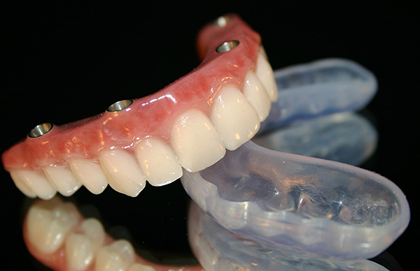Prótesis dental (All-on-4)