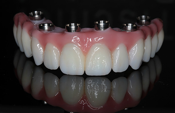 Prótesis dental (All-on-6)