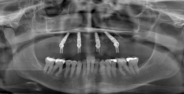 La imagen muestra que dos implantes están fijos verticalmente y dos, en ángulo.