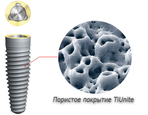 Повърхността на титанови импланти има специално порьозно покритие, което улеснява процеса на натрупване на имплантанта с костната тъкан.