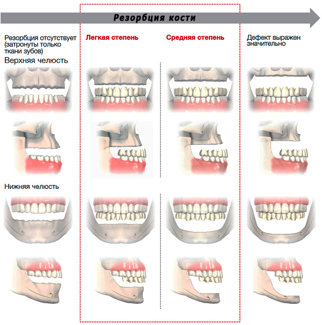 La imagen muestra cómo las mandíbulas de una persona observan diferentes grados de reabsorción ósea.
