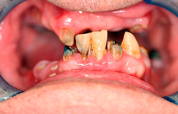 Снимката показва състоянието на зъбите на пациента преди протезата.