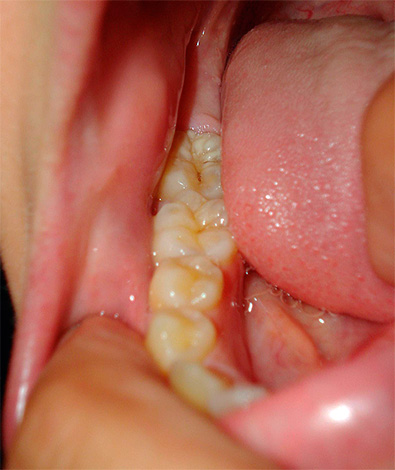 Con un resultado exitoso de medidas terapéuticas, el quiste se resuelve y el diente puede durar muchos años.