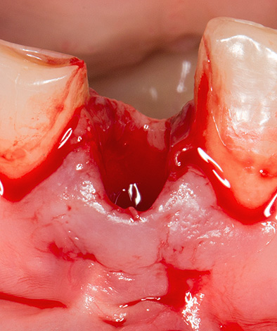 En el agujero lleno de sangre, el médico no puede examinar los fragmentos restantes del diente y los restos del quiste.
