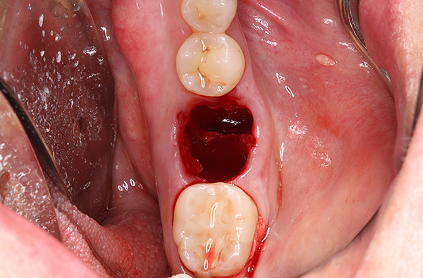 A veces, en un agujero de este tipo, incluso un fragmento de la raíz del diente permanece junto con todo el quiste.