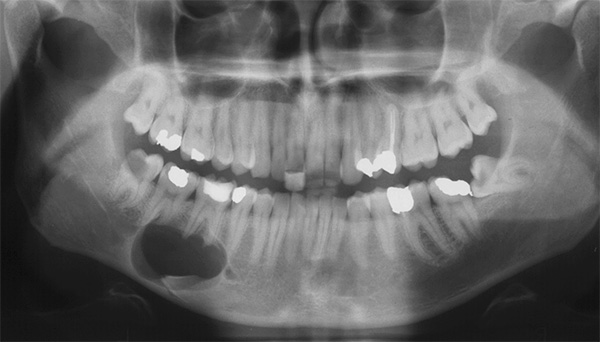 El adelgazamiento del hueso de la mandíbula debido a la pérdida de tejido óseo en el área de un quiste grande puede provocar una fractura incluso con una carga moderada de masticación.