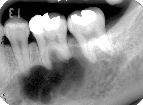 Un ejemplo de una situación en la que un quiste captura las raíces de dos dientes a la vez.