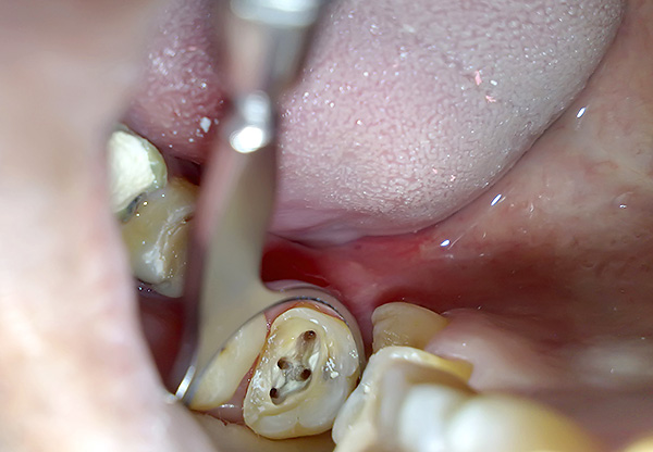 A veces, el quiste en la raíz desaparece después de un tratamiento de calidad de los canales del diente.