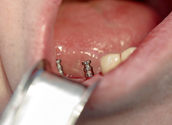 Ας μιλήσουμε για τους σημερινούς τύπους οδοντικών εμφυτευμάτων και τις τιμές αυτής της διαδικασίας ...