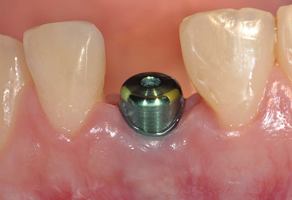 Durante bastante tiempo, el paciente camina con el encías mientras la osteointegración del implante está en progreso.