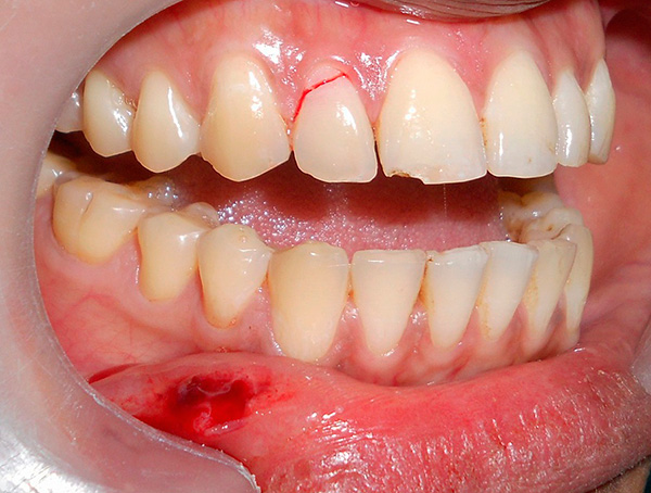 Η φωτογραφία δείχνει σαφώς μια ρωγμή στο δόντι - δεν υπόκειται πλέον σε αποκατάσταση, υποτίθεται ότι αφαιρείται με επακόλουθη προσθετική επίστρωση στο εμφύτευμα.