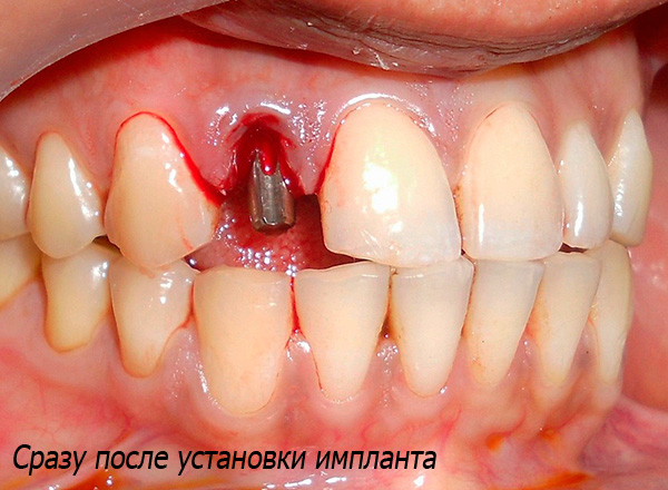 Η ταυτόχρονη εμφύτευση περιλαμβάνει την τοποθέτηση του εμφυτεύματος στην οπή αμέσως μετά την αφαίρεση του δοντιού.