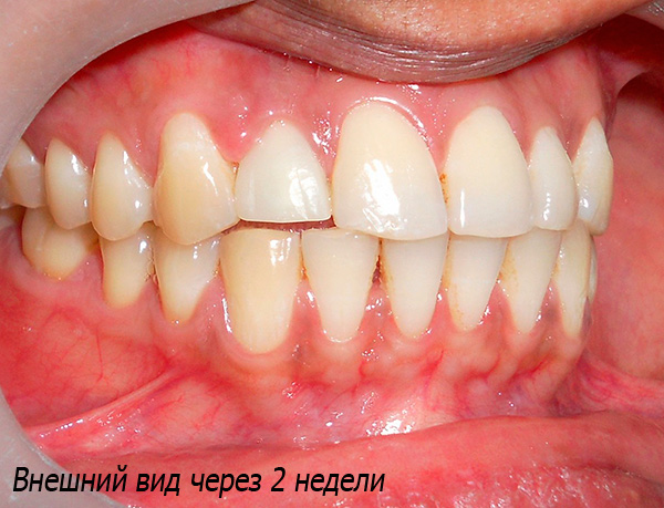 Así es como se ve el resultado de la implantación después de 2 semanas: un diente artificial no se puede distinguir de los parientes.