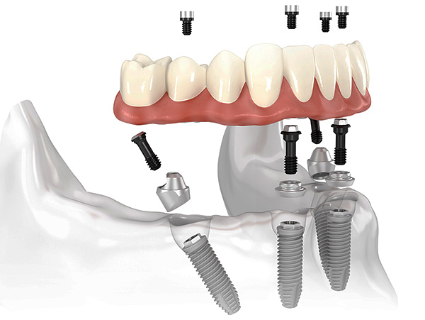 Uno de los tipos más populares de implantes dentales en la actualidad es la tecnología All-on-4.