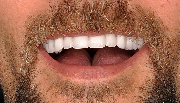 Η εμφύτευση των δοντιών με άμεσο φορτίο επιτρέπει σε σύντομο χρονικό διάστημα να πάρει ένα τέτοιο χαμόγελο σε μια τιμή περίπου 300.000 ρούβλια.