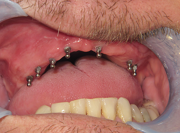 Con la llamada mini-implantación de dientes, la prótesis se puede instalar unos días después de la implantación de los mini-implantes.