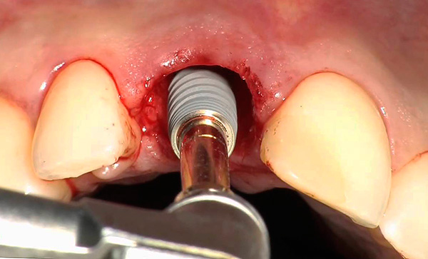 La foto muestra un ejemplo de la instalación del implante en el orificio del diente recién extraído.