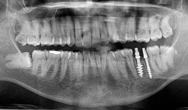 Los llamados implantes basales se implantan en las secciones profundas del hueso de la mandíbula.