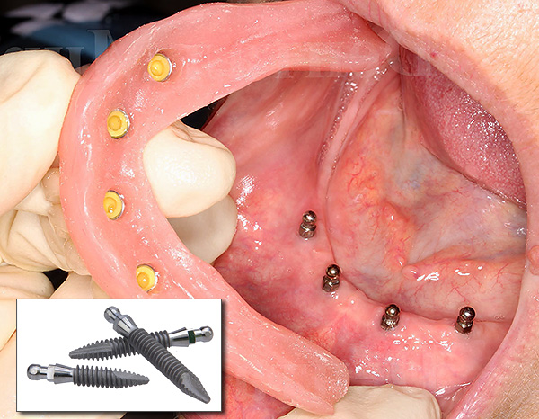 Los miniimplantes ayudan a asegurar la retención de una prótesis removible en la mandíbula.