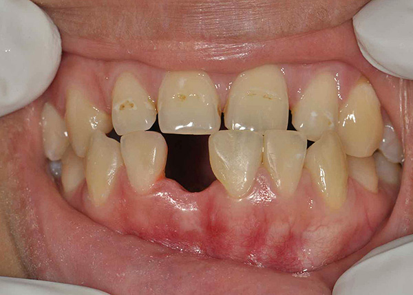Uno de los dientes frontales fue removido en la mandíbula inferior, el agujero ya se había curado.