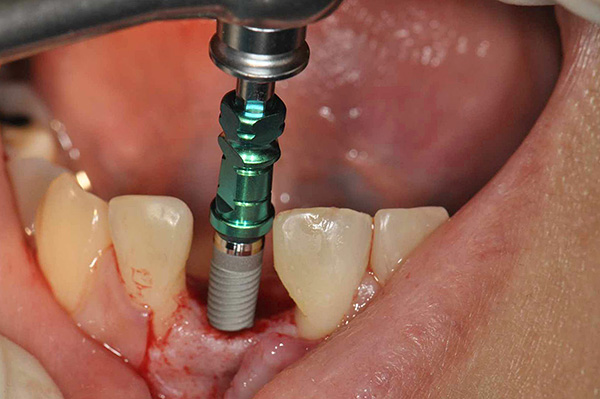 Etapa de instalación del implante dental