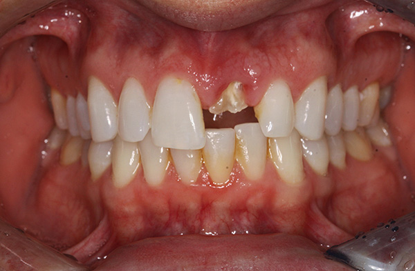 Después de quitar la raíz, el diente frontal se puede restaurar en el implante.