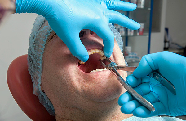 El diente se mantiene firmemente en el ligamento del aparato de los ligamentos, por lo que el médico tiene que hacer esfuerzos significativos al aflojarlo.