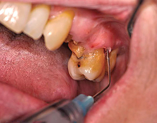 La intensidad de las sensaciones dolorosas durante la extracción del diente depende completamente de qué tan bien se realiza la anestesia.