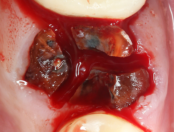 Το δόντι είναι πριονισμένο σε τρία μέρη (με τον αριθμό των ριζών), έτσι ώστε να είναι ευκολότερο να αφαιρεθεί με ελάχιστο τραύμα στους περιβάλλοντες ιστούς.