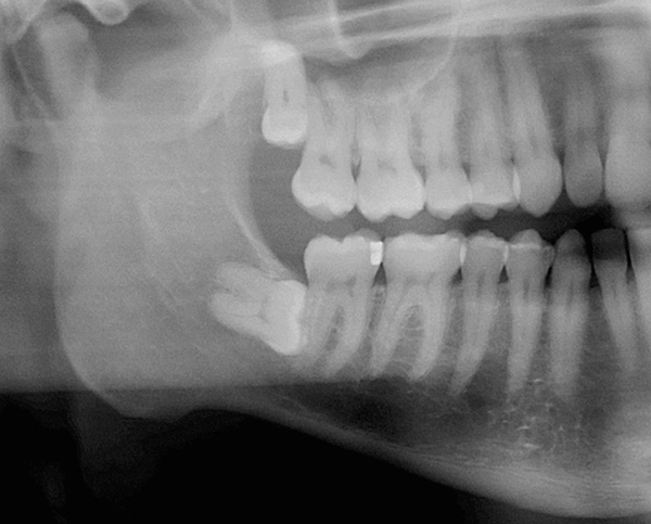 La imagen muestra claramente la muela del juicio impactada yaciendo horizontalmente en los huesos de la mandíbula inferior.