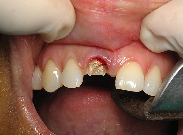 Όχι μόνο η σωστή στάση των ασθενών στο πρόβλημα της εξόρυξης δοντιών και η χαμηλή επίγνωση αυτής της δράσης συχνά οδηγούν σε σοβαρές συνέπειες.