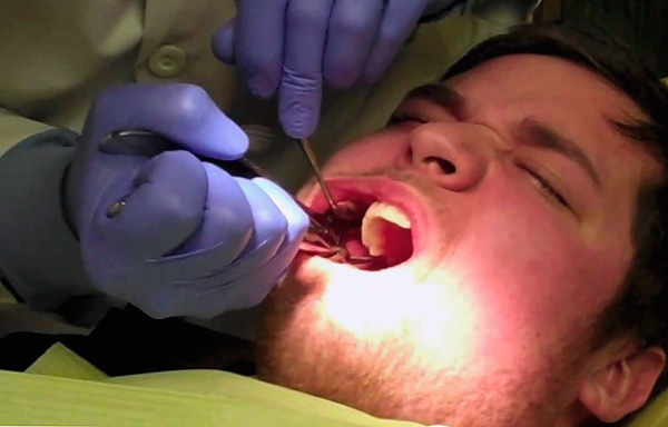 Para que el procedimiento de extracción de los dientes pase sin problemas, es útil conocer algunos matices ...