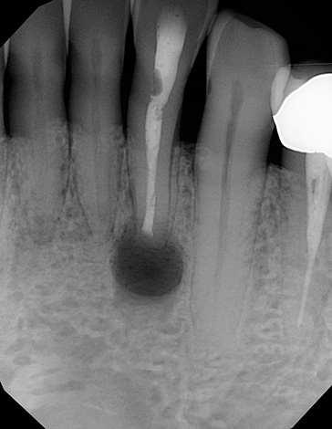 Η εικόνα δείχνει ένα δόντι με κύστη στην περιοχή της ρίζας.
