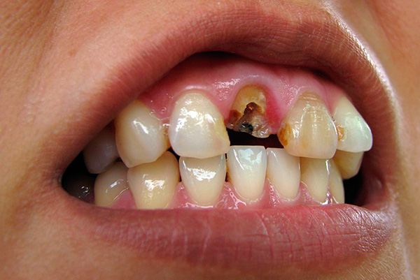Συχνά το δόντι διασπάται έτσι ώστε η ρίζα να μην μπορεί πλέον να χρησιμοποιηθεί ως στήριγμα για τη γλωττίδα και την στεφάνη - στην περίπτωση αυτή, πρέπει να εξάγεται η ρίζα.