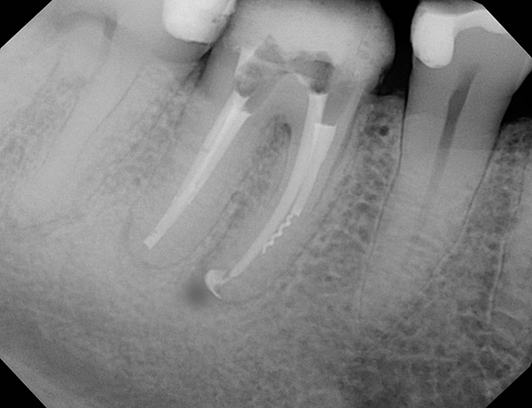La imagen muestra claramente un fragmento de un instrumento dental en el conducto radicular de un diente; a menudo, esto conduce a la inflamación de la raíz con el tiempo.