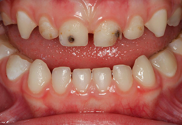 Incluso los dientes de leche, si es necesario, deben tratarse para evitar su pérdida prematura.
