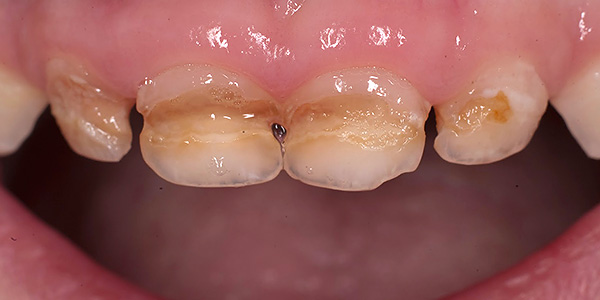 Μια άλλη φωτογραφία με ένα παράδειγμα της τερηδόνας των δοντιών γάλακτος σε ένα παιδί.