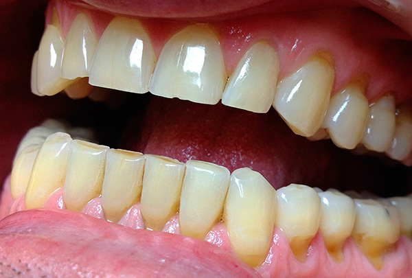 El área de defectos en forma de cuña se caracteriza a menudo por una mayor sensibilidad, ya que el esmalte dental se adelgaza aquí.
