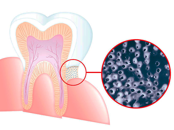 La imagen muestra esquemáticamente la exposición de la dentina en el área cervical del diente: la dentina es penetrada por los canalículos más finos que conducen a la pulpa.