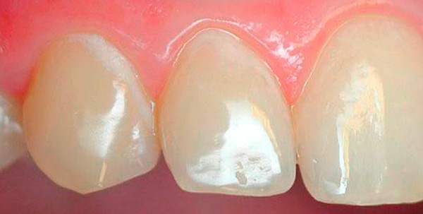 Las áreas blancas en los dientes son zonas de desmineralización intensiva del esmalte (caries en la etapa de mancha blanca).