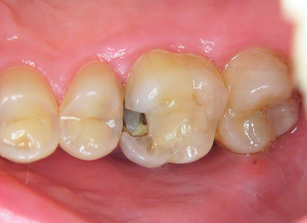 Ni una sola pasta de dientes restaura los dientes si ya se han formado profundas caries en ellos.
