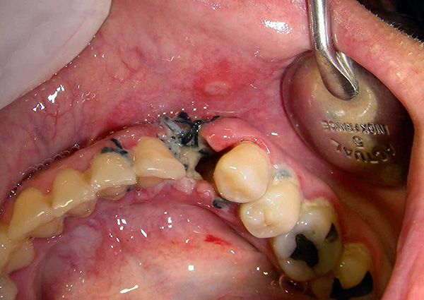 Alveolitis (inflamación del agujero después de la extracción del diente).